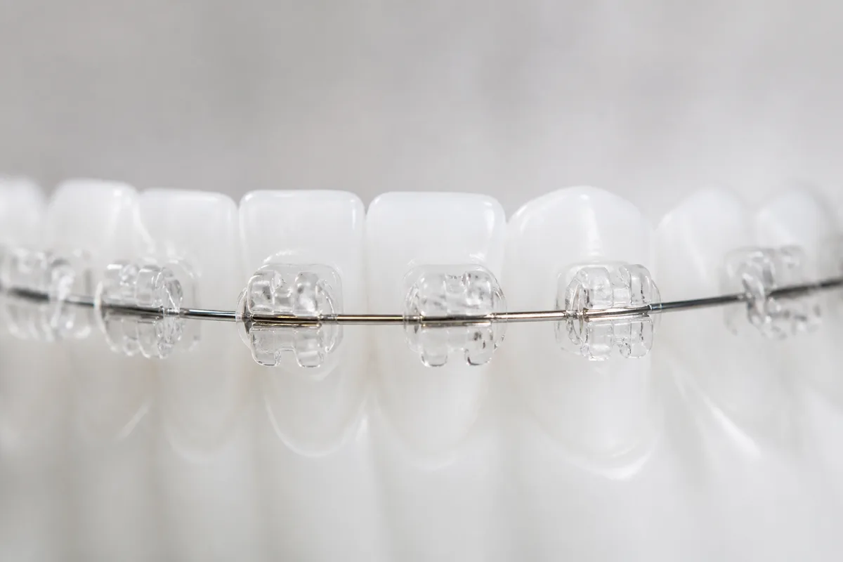 Clear Ceramic Brackets